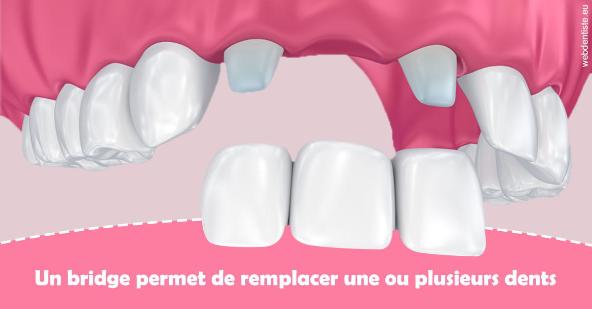 https://www.cabinetaubepines.lu/Bridge remplacer dents 2