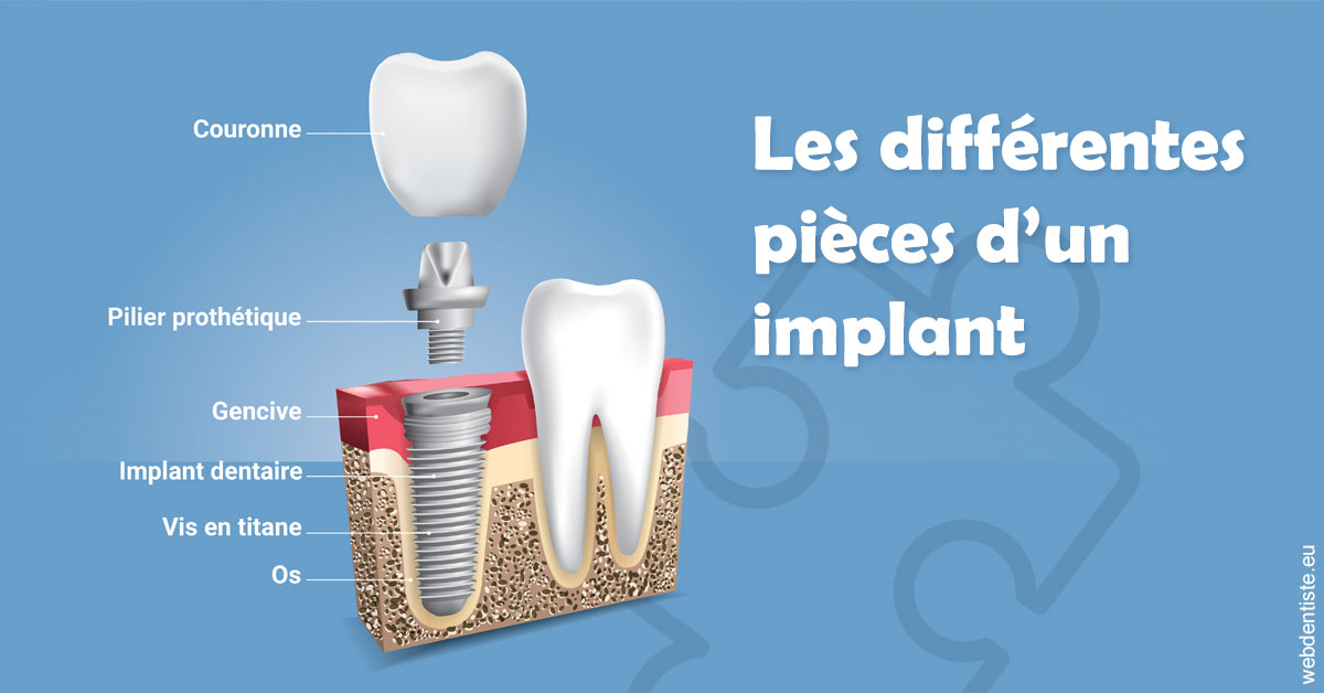 https://www.cabinetaubepines.lu/Les différentes pièces d’un implant 1