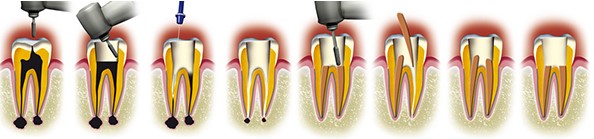 retraitement endodontique