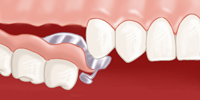 Prothèse dentaire  4.03schema2